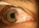 Pterygium Pterygium